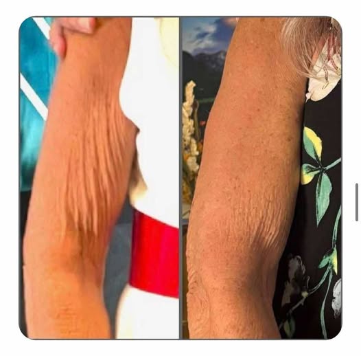 Melissa Before and After